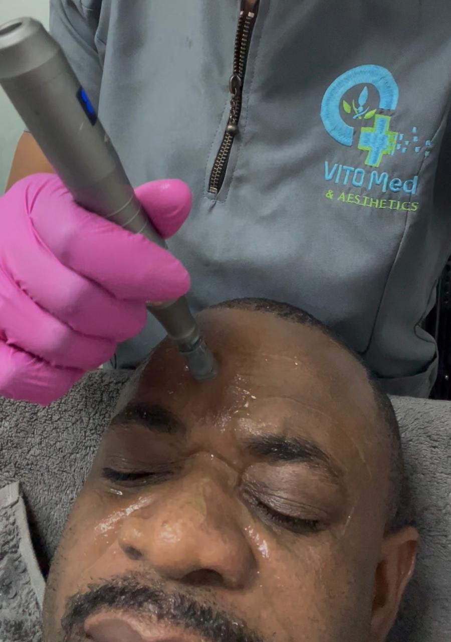 Microneedling treatment at VITO Med & Aesthetics