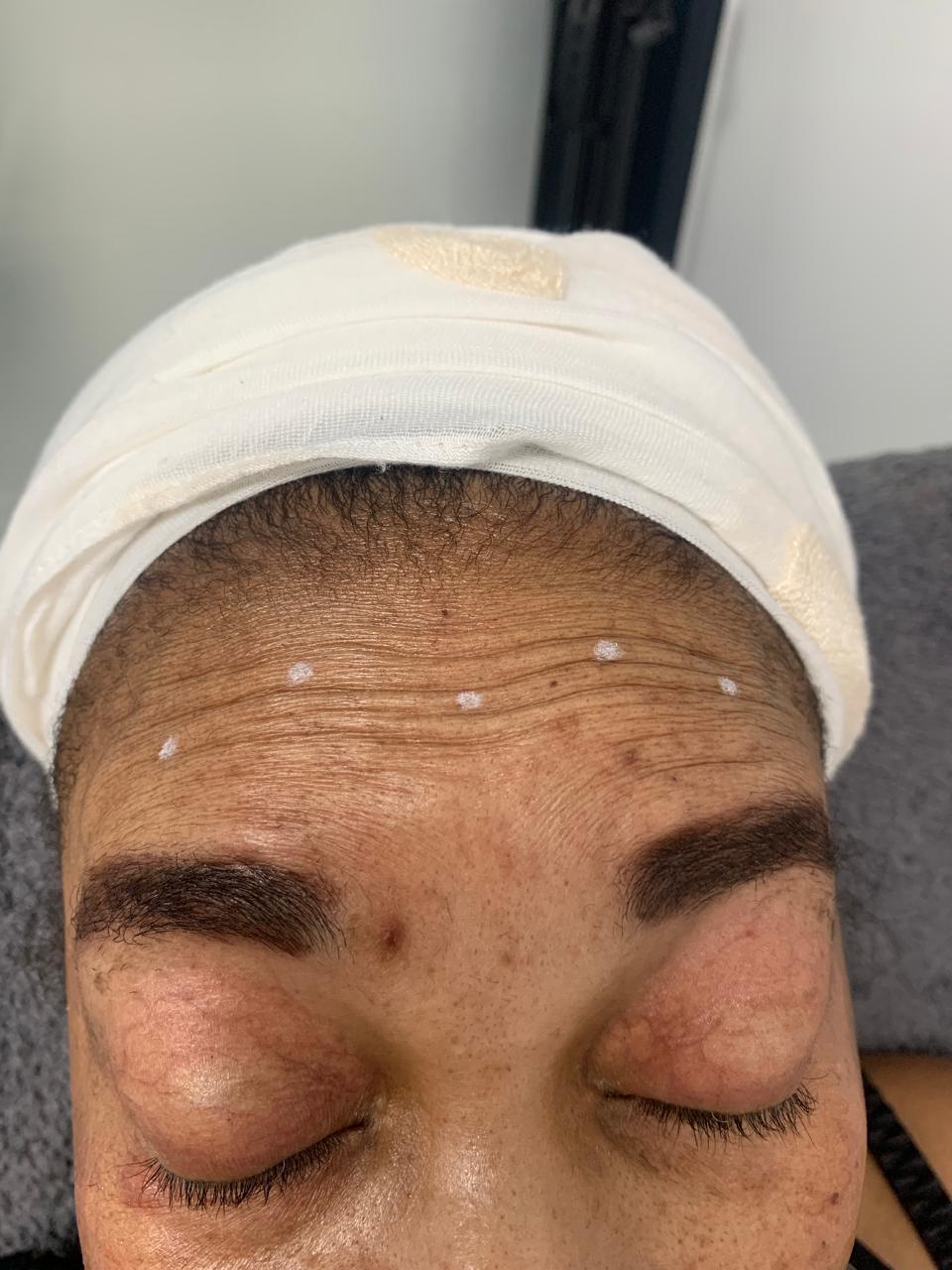 Anti-Wrinkle Treatment